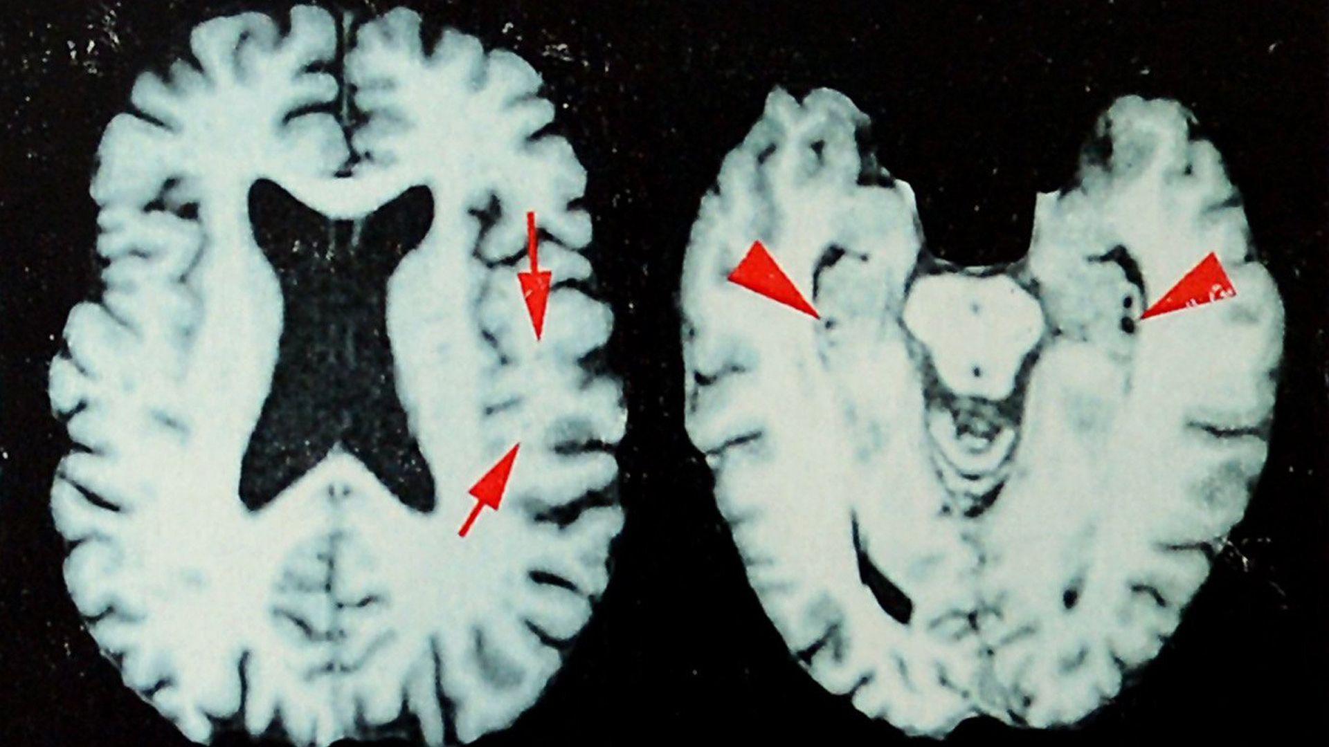 Mind‑Game of Violence: Study Finds Up to 97% of Former NFL Players Dead from Brain Disease