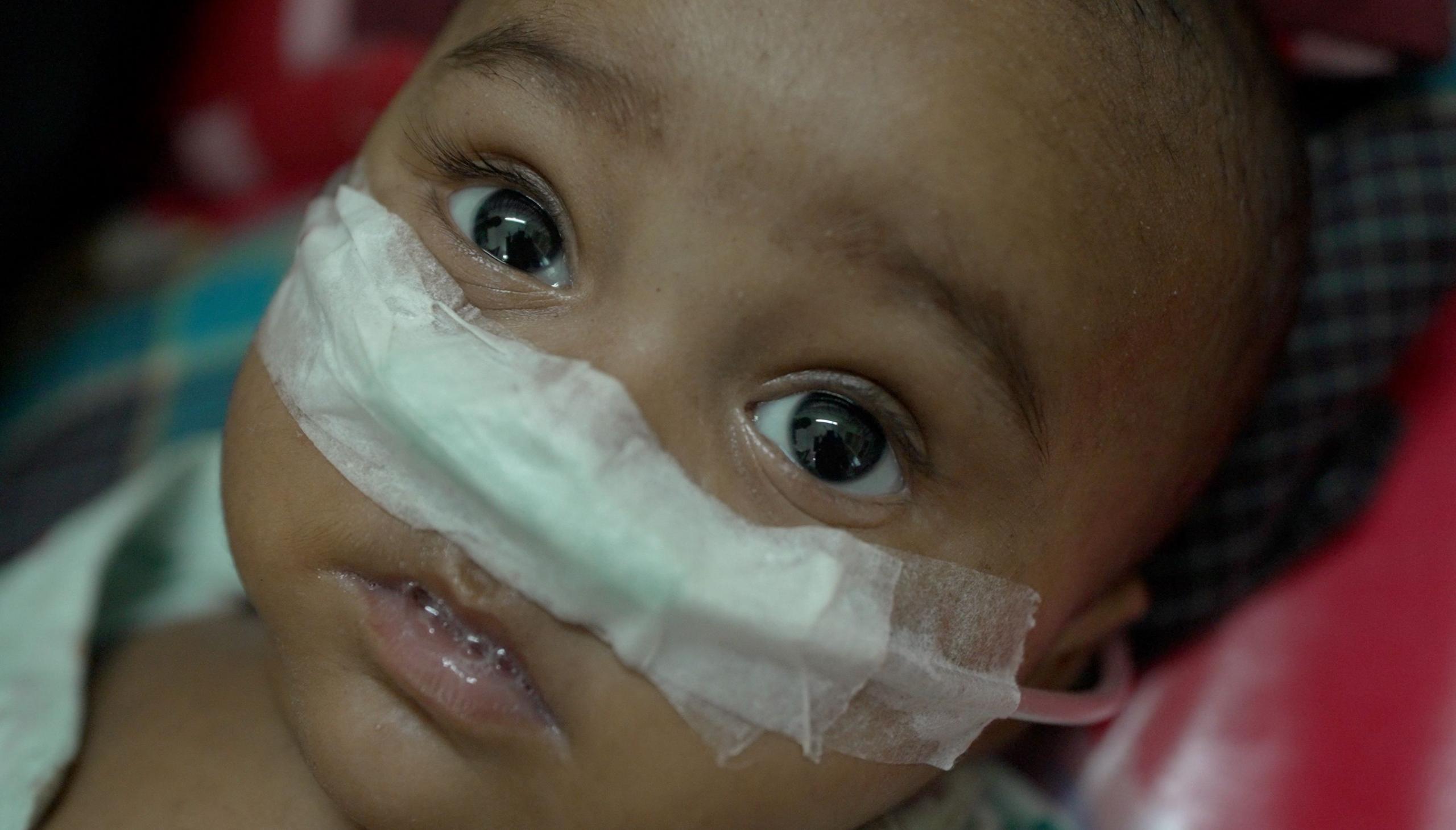 Measles Outbreak in Bangladesh Claims Hundreds of Children Amid Vaccine Shortfall
