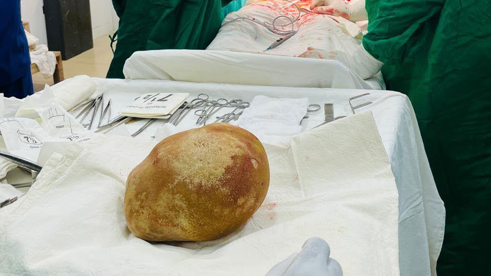 Record‑Setting 3.1‑kg Bladder Stone Removed from Sri Lankan Patient